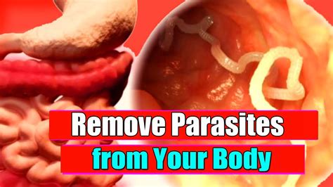 Remove Parasites From Your Body Super Fast Threadworms Treatment Youtube