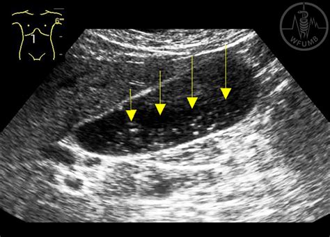 Gallbladder Ultrasound Sludge