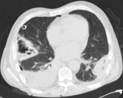 Chest Ct Scan Showing Two Cavitated Lesions With Air Fluid Level In The