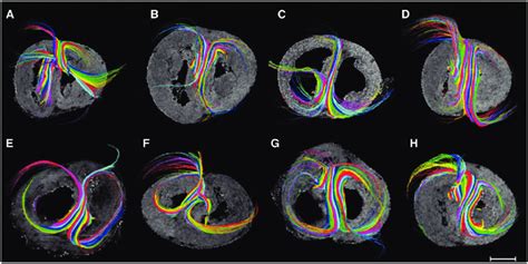 Diffusion Tensor Imaging Tractography In Ventricular Septum Diffusion