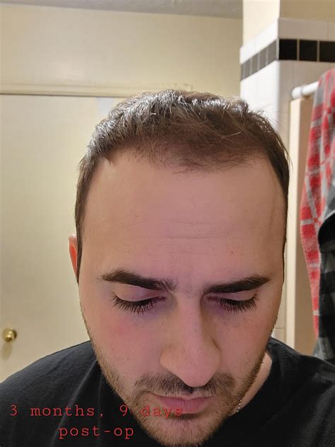 3 month Hair Transplant Update, 2100 grafts. : r/Hairtransplant