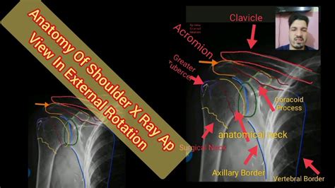 Anatomy Of Shoulder X Ray Ap View In External Rotation Made Simplest