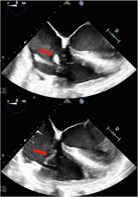 Pre And Post Procedural Transesophageal Echocardiography Imaging Download Scientific Diagram