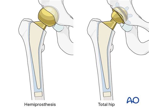 Total Hip Arthroplasty For Transcervical Shear Fractures Of The Femoral