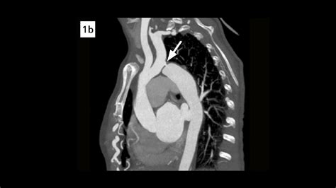 Severe aortic coarctation in an adult - Siemens Healthineers