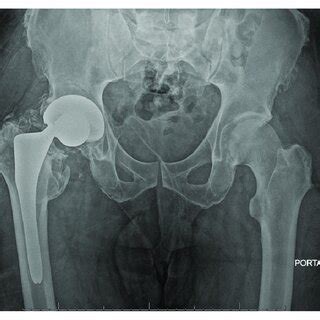 Anteroposterior Pelvis Radiograph Of A Year Old Male Case With