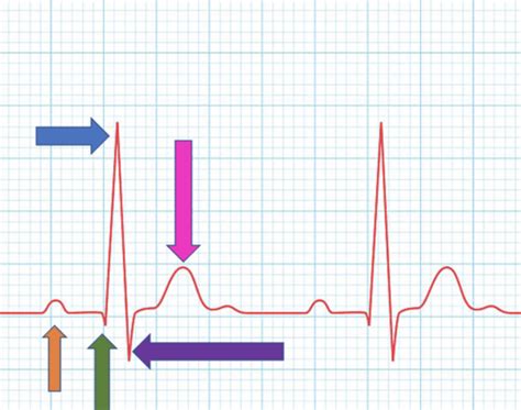 Ekg Flashcards Quizlet