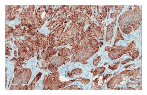 Testicular Granulosa Cell Tumor Histology Sections Of The Testis Show