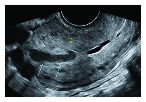 A Transvaginal Ultrasound Showing A Hypoechoic Structure Blue Download Scientific Diagram