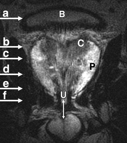 Pretreatment Evaluation Of Prostate Cancer Role Of Mr Imaging And 1h