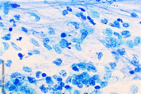 Mycobacterium Tuberculosis Positive Small Red Rod In Sputum Smear Acid Fast Stain Analyze By