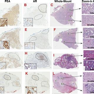 Histo Structural Cellular And Molecular Heterogeneity In Human Pca