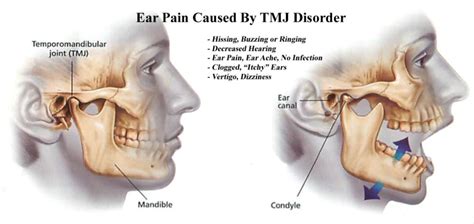 Ear Pain & Ringing | Head Pain Institute