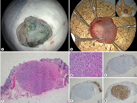 Appearance Of Resected Specimen A B Pathology Of Resected Specimen