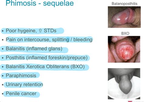 Mild Balanitis Xerotica Obliterans