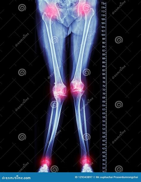 Scanogram Of Lower Limb Or X-ray Image Of Total Lower Extremity With ...