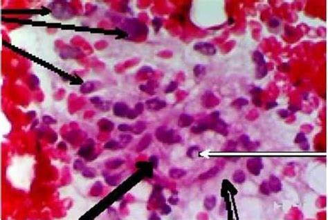 Diagnostic Significance Of Fine Needle Biopsy And Cell Block In Skin