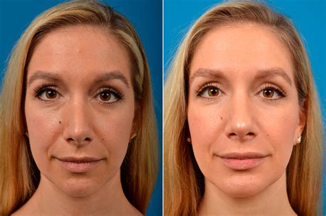 Chin Augmentation Rhinoplasty Photos Melbourne FL Patient 56582