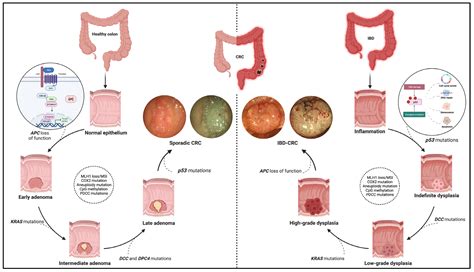 Cancers Free Full Text Inflammation Driven Colorectal Cancer Associated With Colitis From