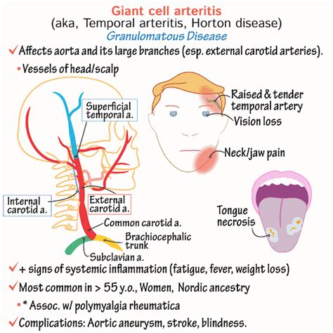 Temporal Giant Cell Arteritis MEDizzy