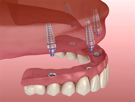 Does Blue Cross Insurance Cover Dental Implants Saintjohn