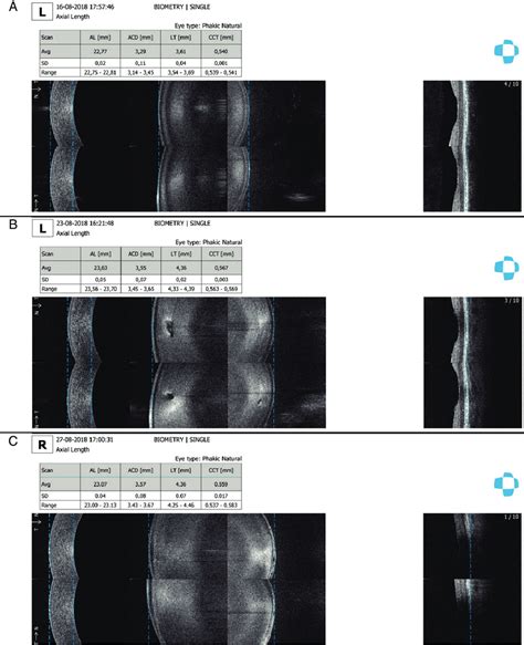 Optical Biometry Obtained By Revo NX Optical Coherence Tomography A