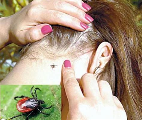 Что делать при укусе клеща: куда обращаться - На пенсии