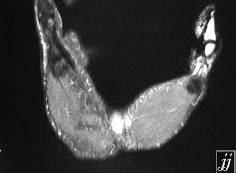 Radioogle Msk Median Nerve Neuritis Or A Tendinitis