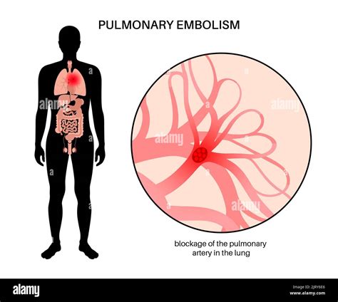 Anatomie Humaine Embolie Pulmonaire Illustration Humain Embolie The