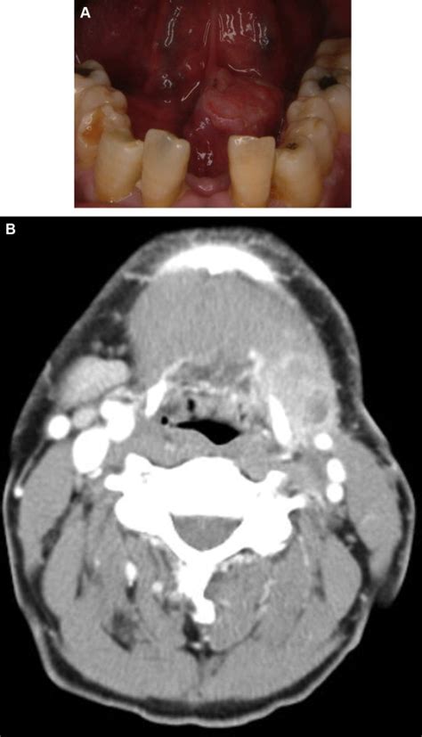 Comparison Of Osteoradionecrosis Of The Jaw After Superselective Intra