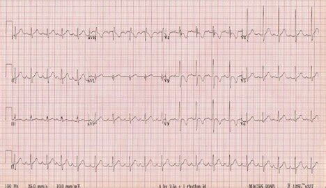 T Wave Inversions — Maimonides Emergency Medicine Residency