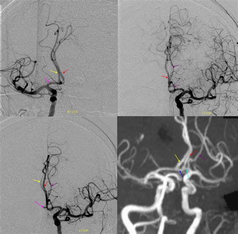 Anterior Cerebral Artery