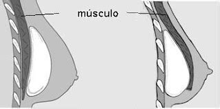 Cirurgia Pl Stica Pr Tese De Mama Submuscular Ou Subglandular