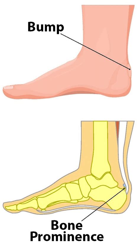 Battling Haglund S Deformity A Journey Toward Relief Foot Ankle