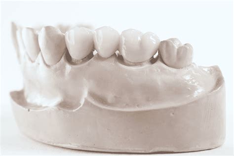 What is a Dental Bridge Procedure?