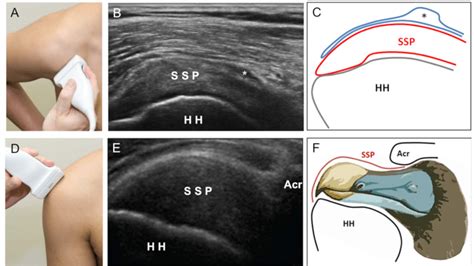 Hip: Normal And Pathology - Internet Book Of MSK Ultrasound