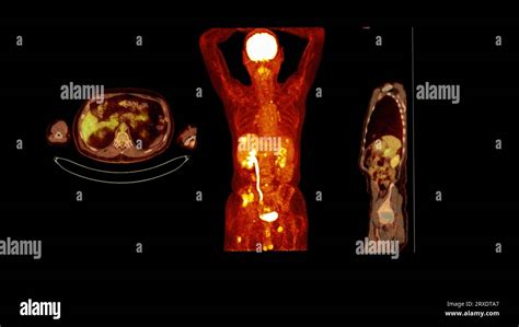 Pet Ct Image Of Whole Human Body Axial Coronal And Sagittal Plane