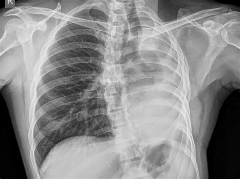 Pneumonectomy-CXR - Sumer's Radiology Blog