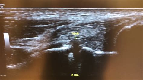 Ultrasound Assessment Of The Ulnar Collateral Ligament Of The Elbow Aka Tommy John Ligament