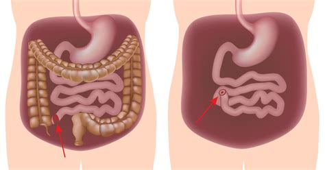 Proctocolectomy Surgery For Ibd Ibdrelief