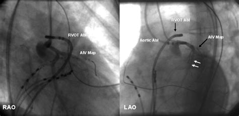 Catheter Ablation Of Idiopathic Ventricular Tachycardia Circulation Arrhythmia And