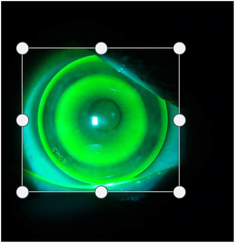 Clinical Tool To Measure Fluorescein Patterns In Orthokeratology Peerj