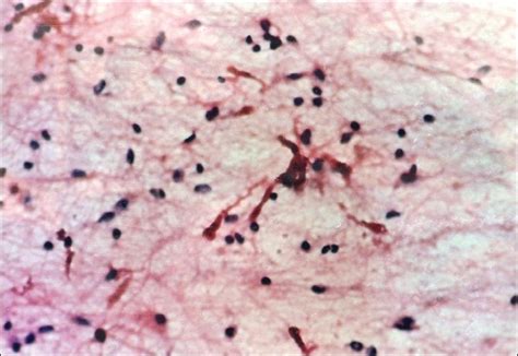 Pilocytic astrocytoma: Squash preparation showing Rosenthal fibres ...