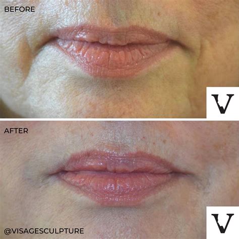 Treating Marionette Lines Boston Cosmetic Injector Restylane Skin