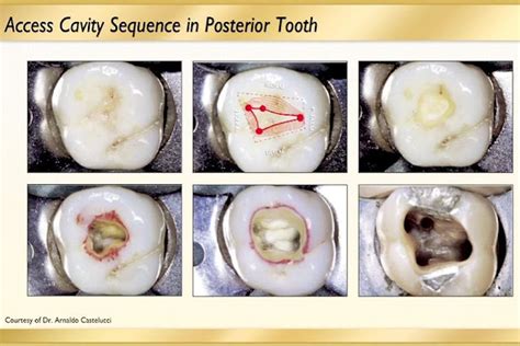 Access Cavity Posterior Access Canal Preparation Dr Troy Mcgrew