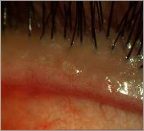 12. View of the meibomian glands seen in 11 after successful mechanical ...