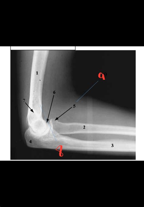 RAD 111 UPPER EXTREMITY Lateral Elbow Xray Diagram Quizlet