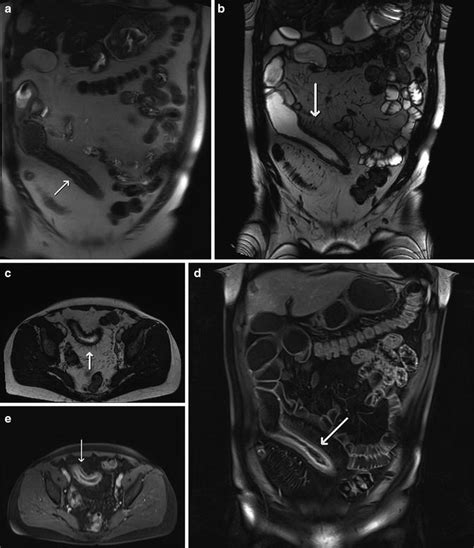 Magnetic Resonance Enterography Abdominal Key