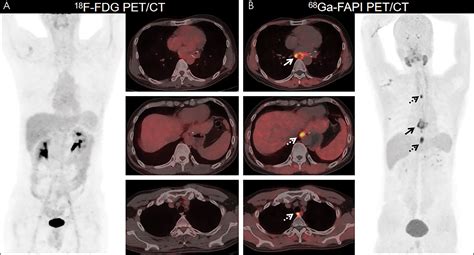 Comparison Of 68Ga FAPI And 18F FDG Uptake In Gastric Duodenal And