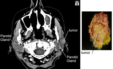 Parotid Gland Ct Scan